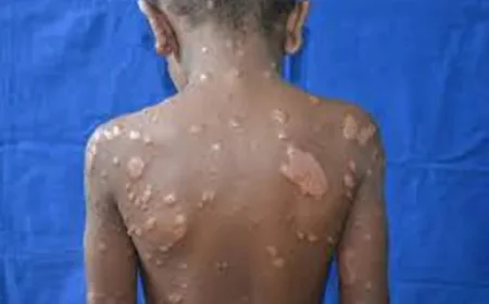 Urgent Call for Awareness and Social Action to Eradicate Leprosy