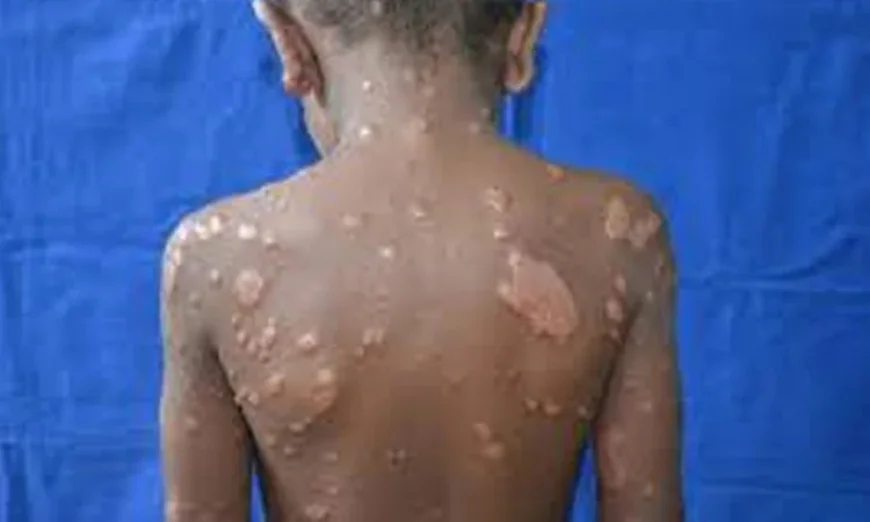 Urgent Call for Awareness and Social Action to Eradicate Leprosy