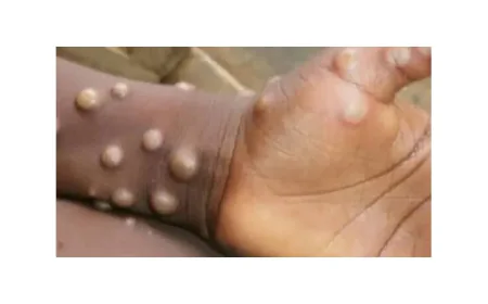 Ghana Reports Its First Mpox Fatality Amid Rising Cases