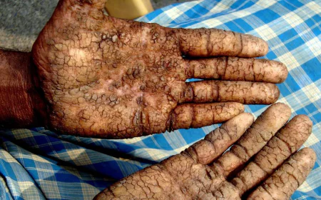 Arsenic Found in Rice and Vegetables; Public Health at Risk