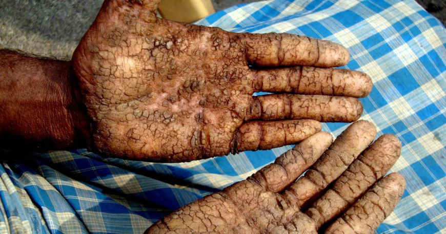 Arsenic Found in Rice and Vegetables; Public Health at Risk